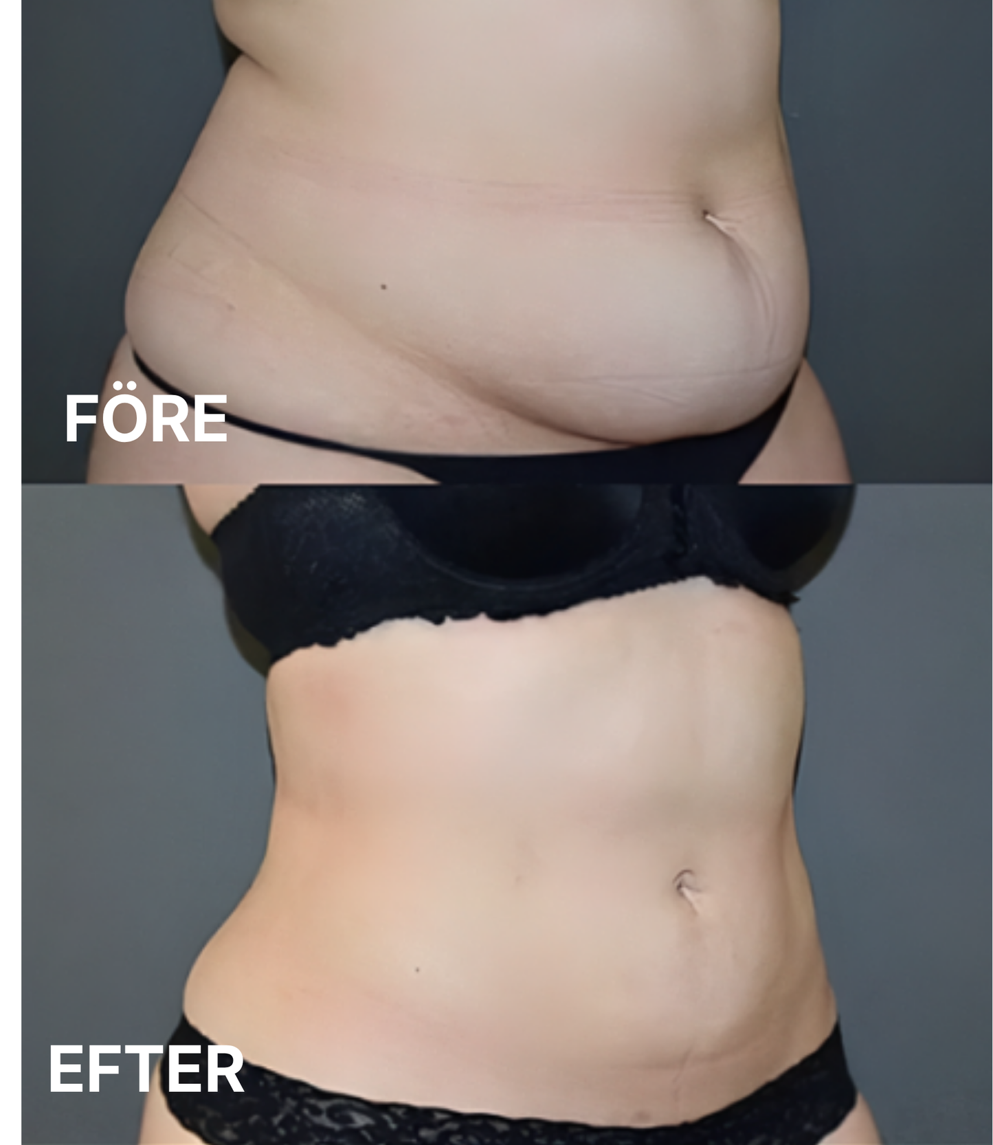 Slim Body Perfection™ - Framtidens skönhetsvård hemma