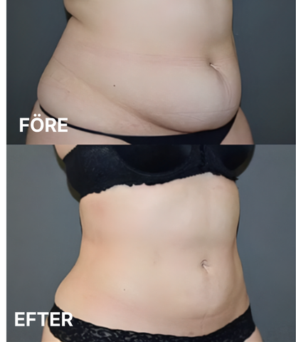 Slim Body Perfection™ - Framtidens skönhetsvård hemma