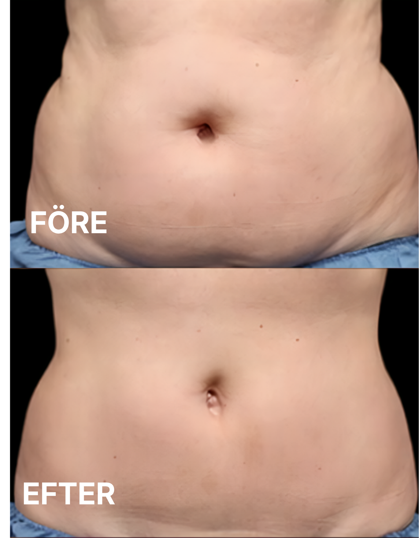 Slim Body Perfection™ - Framtidens skönhetsvård hemma